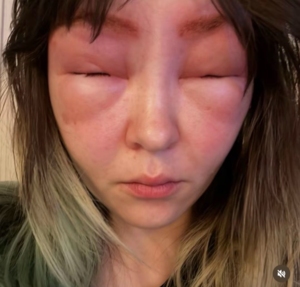 눈썹 염색했다 ‘이렇게’ 됐다…끔찍한 부작용 30대 여성 경고