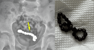‘1년 간 복통 호소’ 4세 남아 뱃 속에서 나온 ‘OO 뭉치’