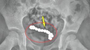 “어? 이게 뭐지?”…1년간 복통 호소 4세 남아, 검사해본 의사 ‘충격’