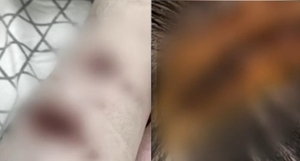 “물려 죽겠구나”…애견카페 갔다가 맹견 4마리에 질질, 머리·다리 공격받은 20대女