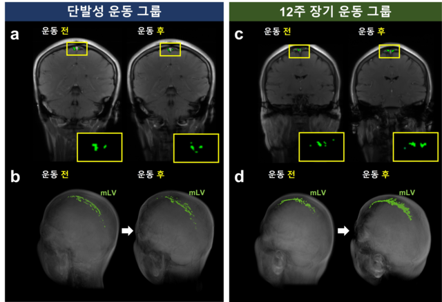 단발성 운동과 장기 운동에 따른 뇌막 림프관 영역 크기 변화를 확인할 수 있는 자기공명영상(MRI). 장기 운동 그룹은 운동 후 뇌막 림프관 영역이 뚜렷하게 증가한 모습을 볼 수 있다. 서울대학교 제공