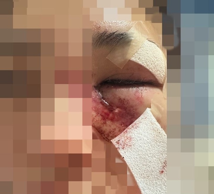 ‘이별통보’한 여친 무차별 폭행, 광대뼈 함몰…여친 모친에 보낸 메시지엔