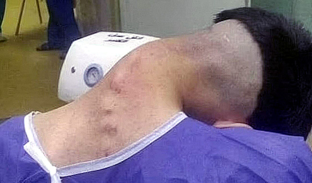 이란 알자흐라 대학병원 의료진이 공개한 23세 남성의 ‘머리떨굼증후군’ 사례.