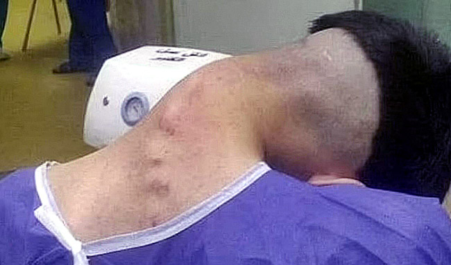 90도 목 꺾인 20대男…의료진 경악한 마약 부작용