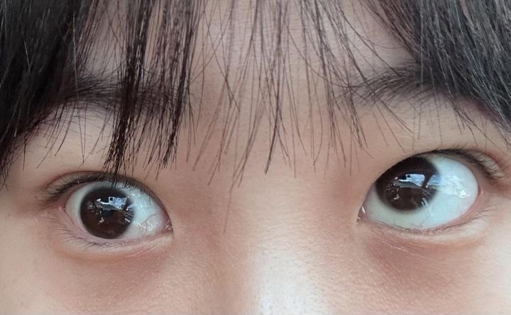 대구서 눈성형 후 ‘사시’된 여성…병원은 명예훼손 내용증명