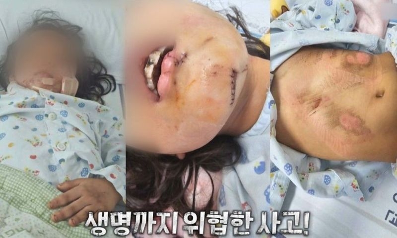초등女 영구치 3개 빠졌다…80대 무면허 운전자 사고
