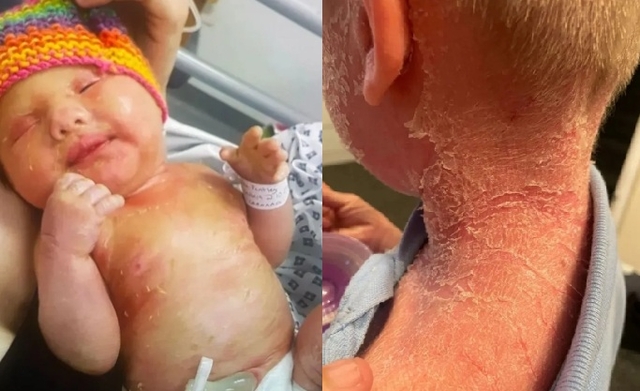 피부 전체가 비늘처럼 갈라지는 케이든의 모습. 더 선 뉴시스