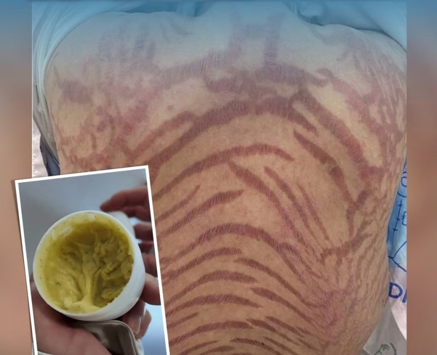 인터넷서 산 ‘연고’ 썼더니 온몸에 ‘뱀 무늬’가…부작용 원인은?