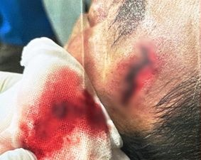 B 씨가 입은 상처. 뉴시스 독자 제공