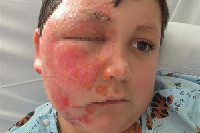 화상을 입은 9살 소년. SNS 갈무리