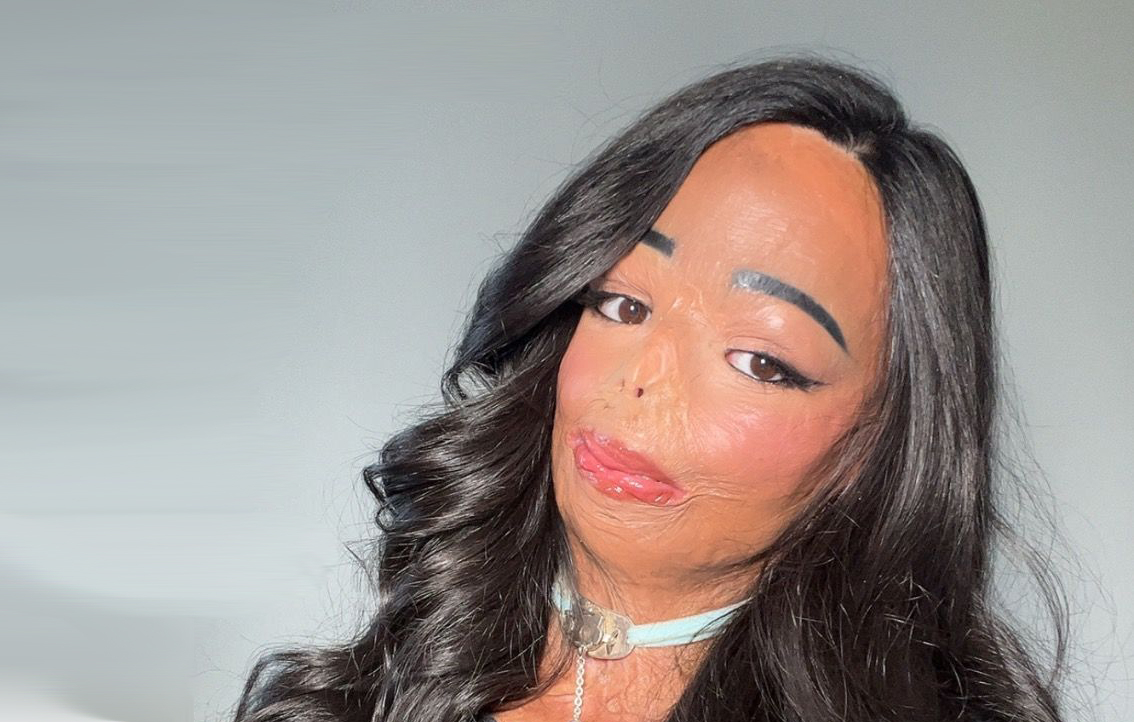 “샴푸 썼다가 온몸이…” 전신 3도 화상 트라우마 이겨낸 21세 영국 여성