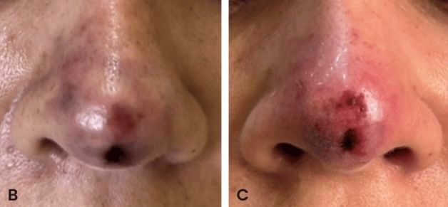 30대 女, 코 필러 시술받았다가 ‘피부 괴사’ 직전까지…왜?