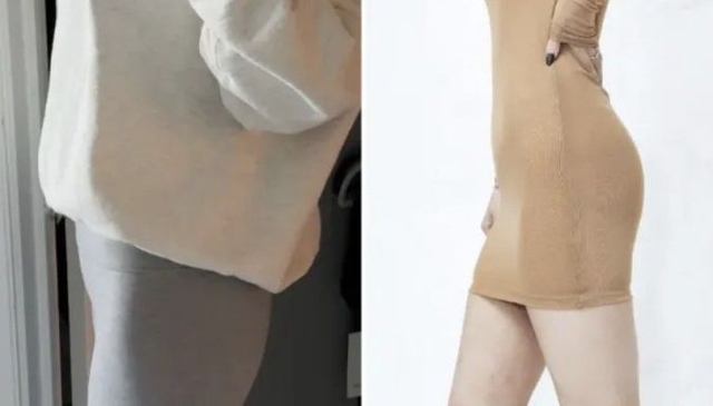 기증받은 지방으로 성형 시술을 진행한 뒤 모습. 더런 스미스