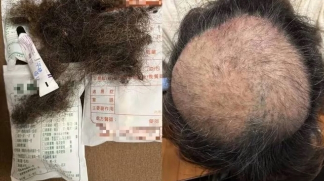 대만에서 한 남성이 식당 악취로 극심한 스트레스를 받아 탈모에 이르렀다고 주장하며 게시한 사진. 스레드