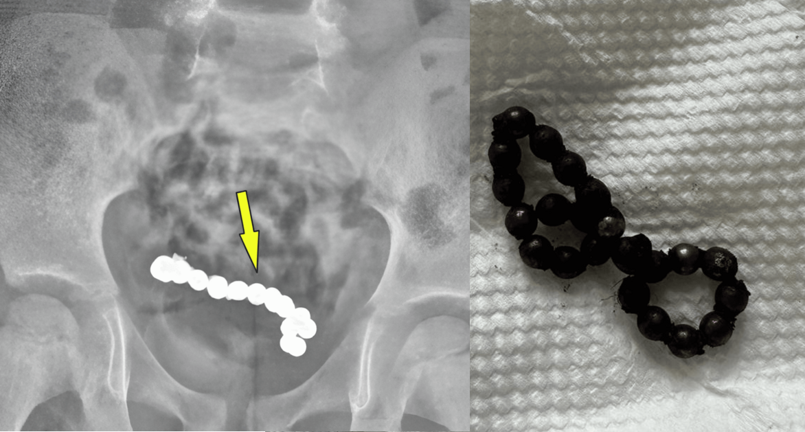 ‘1년 간 복통 호소’ 4세 남아 뱃 속에서 나온 ‘OO 뭉치’