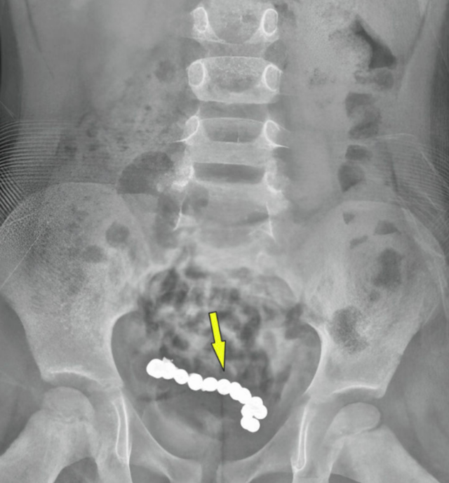 1년 동안 복통을 호소한 4세 남아의 뱃속에서 22개의 자석 조각이 발견돼 충격을 주고 있다. 큐레우스 캡처