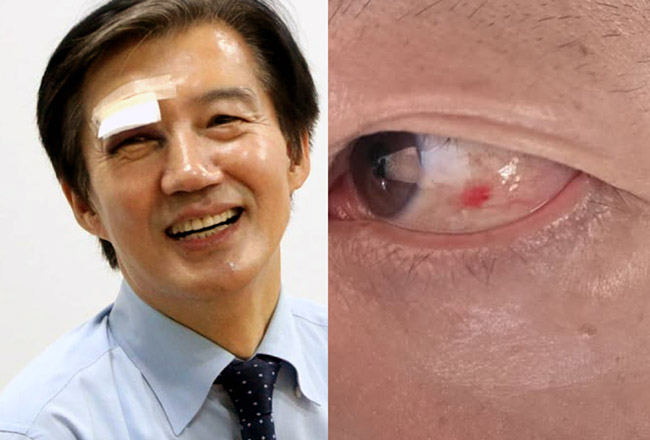“오른쪽 눈에 멍” 조국, 실핏줄 터진 김용남