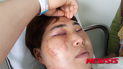 【춘천=뉴시스】 2일 한국 남자 역도 최중량급 기대주 황우만 선수가 국가대표 메달리스트인 사재혁 선배 선수로 부터 폭행을 당해 전치 6주의 상해를 입고 춘천시내 병원에서 치료를 받고 있다.