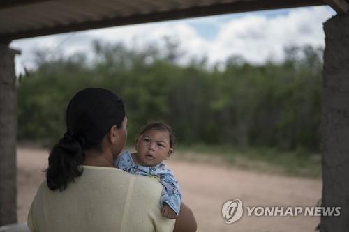브라질의 소두증 아기 (AP=연합뉴스)