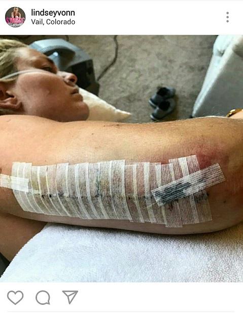 수술 받은 직후 본의 모습. [린지 본 인스타그램 캡처]