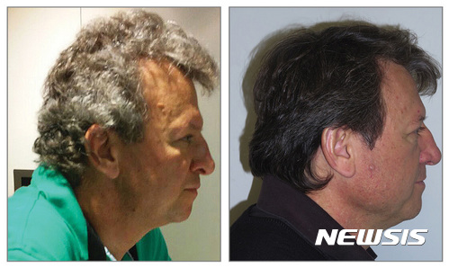 【시카고=AP/뉴시스】 한 폐암 환자가 스페인 연구진이 개발한 한 항암 치료 약물을 복용한 이후 흰머리 대신 갈색머리가 자라나는 신기한 경험을 했다. 사진은 약물 복용 전후의 모습.