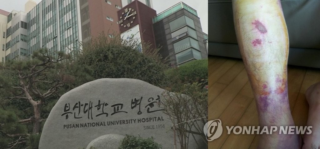 부산대학교 병원과 지도교수 폭행으로 피멍든 전공의 다리[연합뉴스TV 제공, 유은혜 의원실 제공=연합뉴스]