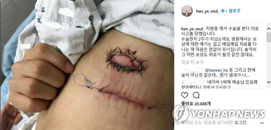 한예슬이 지난 20일 자신의 인스타그램에 수술 부위 사진을 올리고 “지방종 제거 수술을 받다 의료사고를 당했다”고 주장했다. 2018.4.21 [한예슬 인스타그램 캡처=연합뉴스]