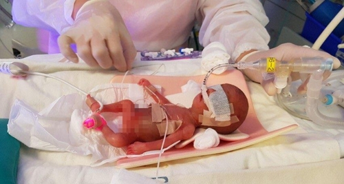 사랑이가 서울아산병원 신생아중환자실 인큐베이터에서 기관지 내로 폐표면활성제를 투여 받으며 치료를 받고 있다 (태어난 지 이틀째 된 사랑이의 모습). [서울아산병원 제공=연합뉴스]