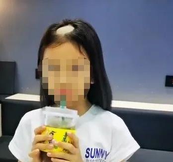 중국서 어린 소녀 1주일여만에 돌연 탈모…‘고양이 때문’ [봉황망 캡처.재판매 및 DB 금지]