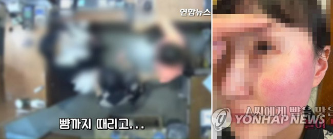 (서울=연합뉴스) 폭행 혐의로 경찰 조사를 받고 있는 주한 벨기에 대사 부인에게 뺨을 맞은 피해자인 옷가게 점원과 가족이 볼이 부은 사진과 폭행 당시 CCTV 영상을 20일 공개했다. 2021.4.20 [연합뉴스 TV 캡처]