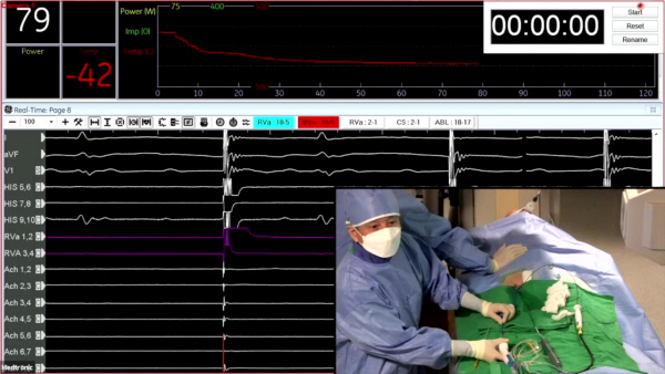 비대면 라이브 부정맥시술 모습