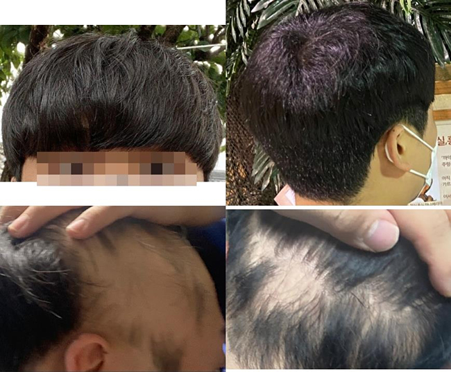 위쪽은 백신 맞기 전의 풍성한 머리카락이고 아래는 백신 맞은 후 3개월이 지난 최근의 모습. 제보자 A씨 제공. 재판매 및 DB 금지.