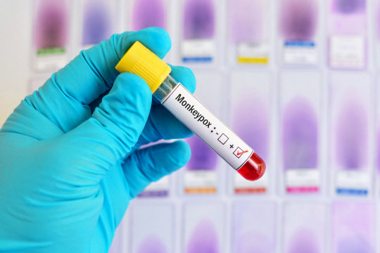Blood sample tube positive with Monkeypox virus, new epidemic disease in 2022
