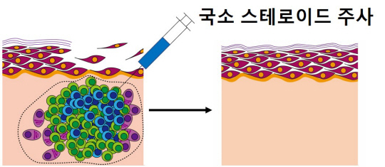 만성 재발성 천포창에 국소 스테로이드 주사치료를 하기 전, 후 피부 병변의 변화