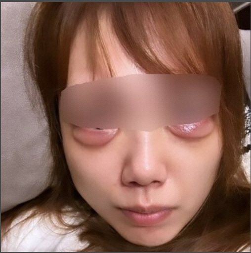 눈밑 애교살 시술을 받았다가 얼굴을 망쳐버리고 말았다는 일본 인플루언서의 시술 뒤 사진. 슈에이샤 캡쳐