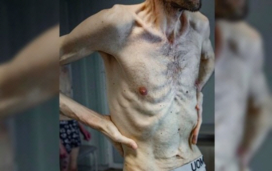 미하일로 포돌랴크 우크라이나 대통령 고문이 5일(현지시간) SNS에 공개한 송환 포로의 모습. X 캡처