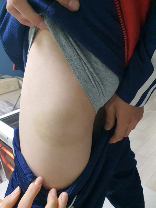 피해 아동의 다리에 난 멍자국. 피해 아동 측 제공 연합뉴스