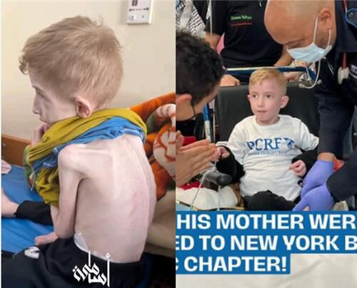 지난 3월 가자지구 병원에서 치료받던 파디의 모습.(왼쪽) 오른쪽은 지난 5월 미국에서 건강을 되찾은 모습. 인스타그램 캡처