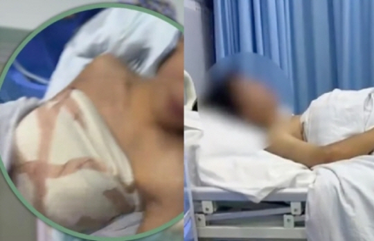 지적장애가 있는 19세 중국 소년이 병원 직원 말에 속아 가슴 확대 수술을 받은 후 다시 제거했다. SCMP 캡처