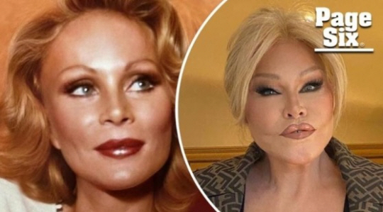 조슬린 윌든스틴의 과거 사진과 최근 사진을 비교한 이미지. 페이지식스(Page Six) X 게시물 캡처