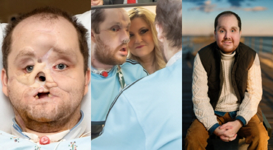 데릭 파프의 안면이식 수술 전후 모습. 메이요 클리닉 제공. 뉴시스