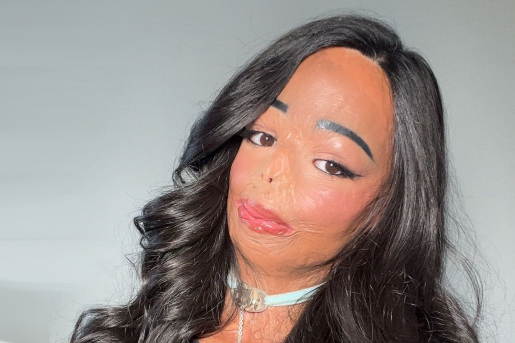 전신 3도 화상, 두 달간 혼수상태… 트라우마 이겨낸 21세 여성